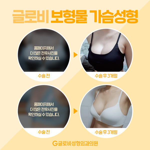가슴성형비용, 모티바 멘토 세빈 어떻게 다를까 관련 이미지 7