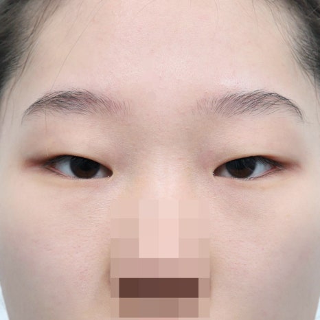 쌍꺼풀수술 재수술 시기, 언제 시작하는 게 좋을까? 관련 이미지 3