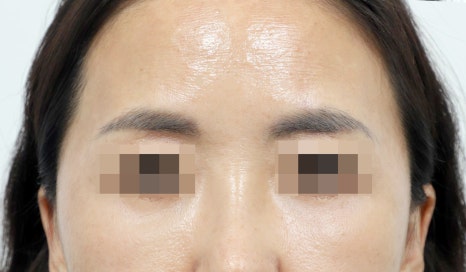 Lower Eyelid and Upper Eyelid Surgery: Should They Be Performed Together as You Age? image 9