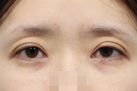 Sleepy-Looking Eyes: Causes to Check Before Simple Double-Eyelid Surgery image 5