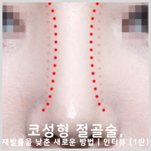 코성형 절골술, 재발률을 낮춘 새로운 방법 | 인터뷰 (1탄) 관련 이미지 1