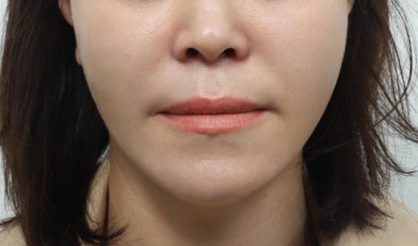 Thread Lifting in Sinsa-dong: Why You Shouldn’t Have It Done Exactly the Same Way as Before image 3