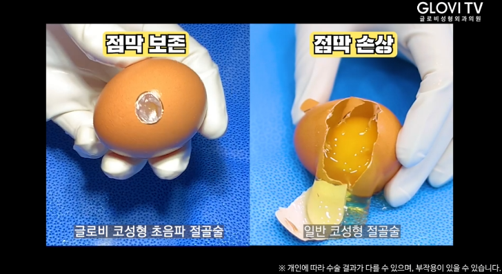압구정역성형외과 코성형, 초음파절골술로 안전하게 관련 이미지 23