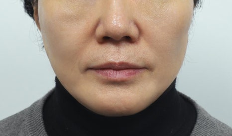 처진 얼굴 리프팅, 나이보다 더 들어보인다면? 관련 이미지 4