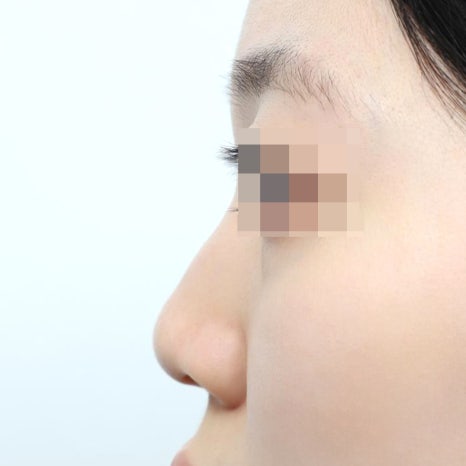 코성형후붓기, 수술 후 한 달이 가장 힘들다는 말, 진짜일까 관련 이미지 8