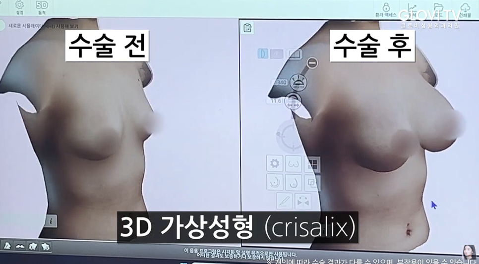 Breast Augmentation: Body Proportions You’ll Definitely Regret If You Only Increase the Size image 4