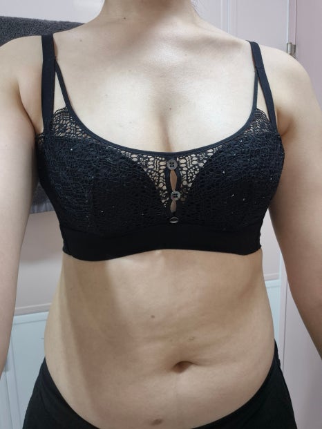 Breast Fat Grafting Price Information and Analysis of Cost Differences by Condition image 3