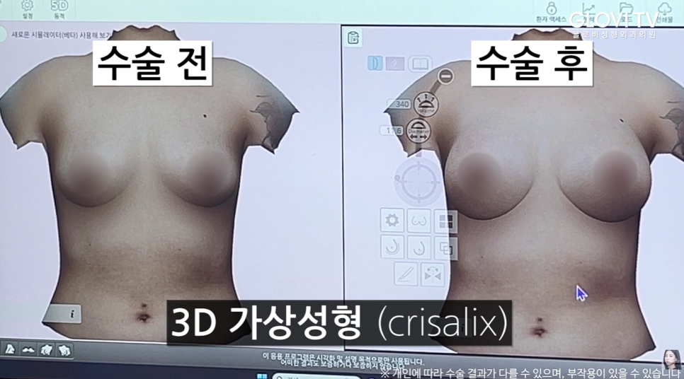 가슴성형 시뮬레이션, 크리살릭스로 수술 전에 미리 볼 수 있다면? 관련 이미지 5