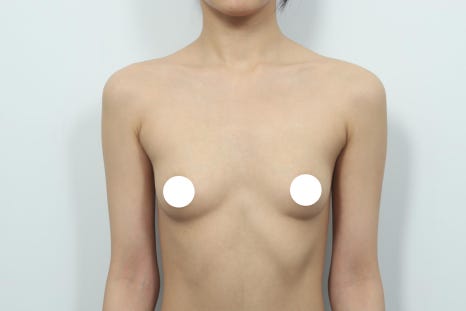 가슴수술 가격, 상담 받기 전에 반드시 확인해야 할 것들 관련 이미지 7