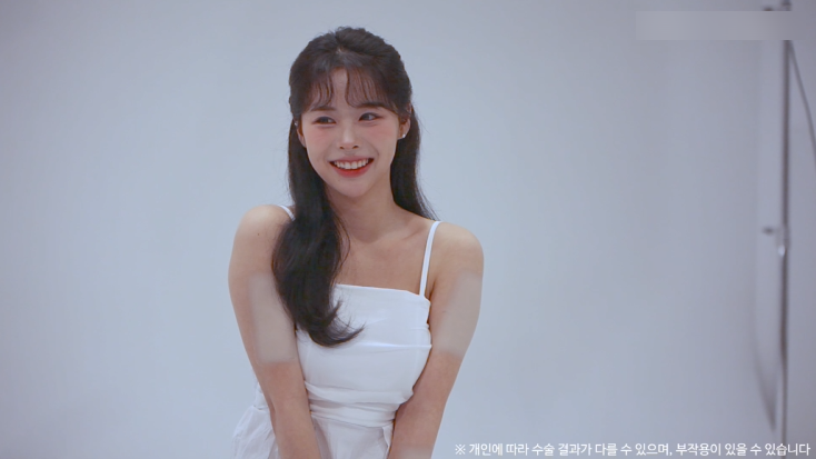 눈밑지방재배치수술 리얼후기 2탄｜수술 한달 후 경과확인! 관련 이미지 13