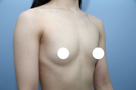 가슴성형잘하는곳, 기술보다 먼저 확인해야 할 기준이 있습니다 관련 이미지 4