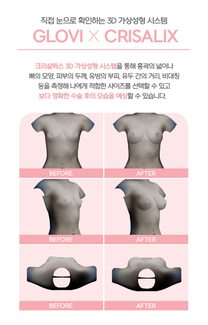 가슴성형 종류, 보형물 선택 시 놓치지 말아야 할 것 관련 이미지 5