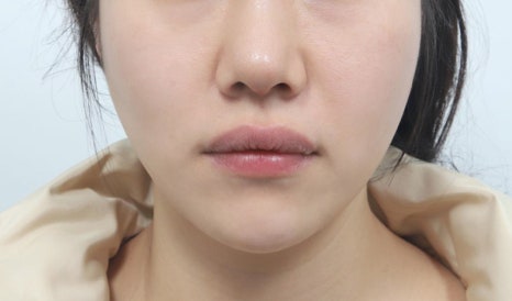 실리프팅 광대 부각, 처진 살 올리려다 얼굴 더 커 보이는 이유 관련 이미지 3