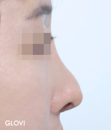 압구정 코재수술, 실패의 원인부터 분석해야 하는 이유 관련 이미지 5