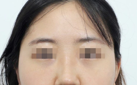강남 눈밑지방재배치, 눈 밑 지방을 정리하는 방법 관련 이미지 6
