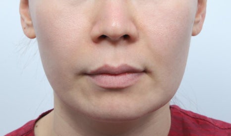 Gangnam Thread Lifting: Addressing Lifting Concerns Without Surgery image 3