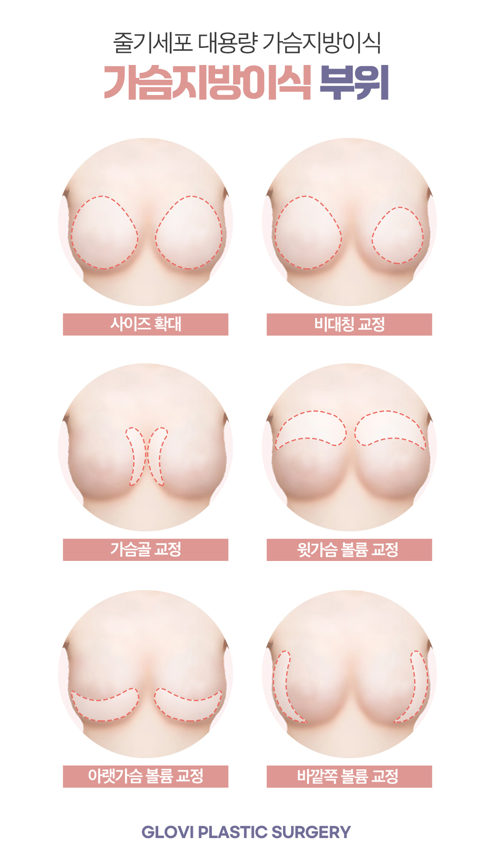 강남가슴성형, 지방이식전 알아둬야할 체크리스트 관련 이미지 3