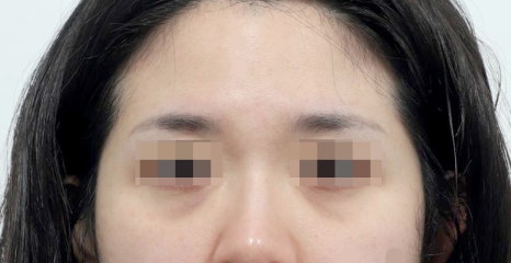 Side Effects of Lower Eyelid Fat Repositioning: Symptoms of Conjunctival Edema and Individual Recovery Processes image 3
