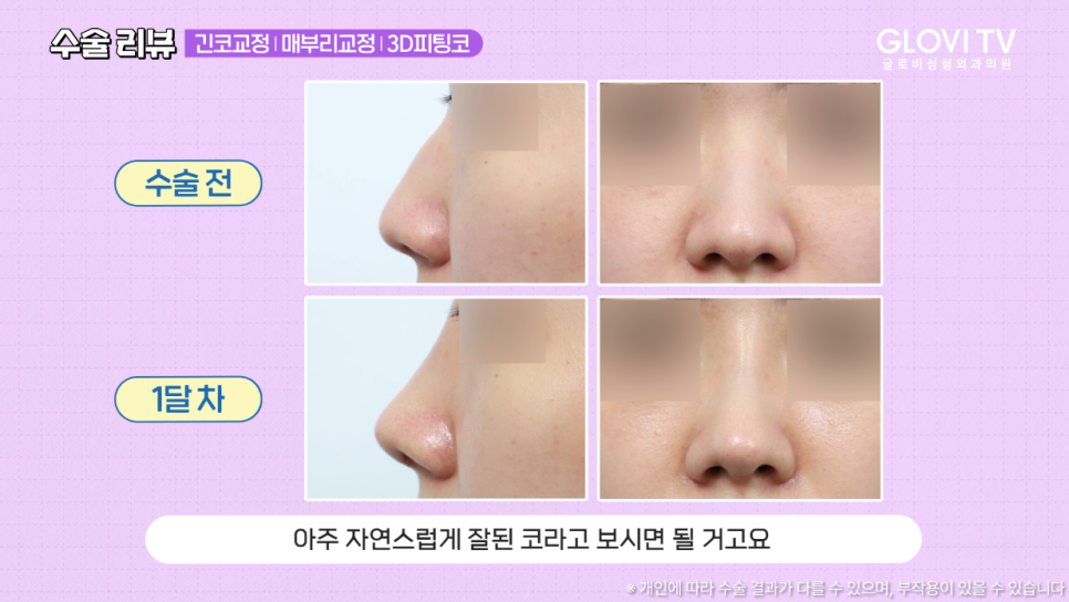 매부리코 긴코 코성형 리뷰, 글로비 3D 피팅코수술 관련 이미지 9