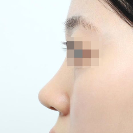코성형후붓기, 수술 후 한 달이 가장 힘들다는 말, 진짜일까 관련 이미지 9