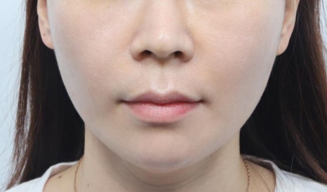Gangnam Thread Lifting: Addressing Lifting Concerns Without Surgery image 4