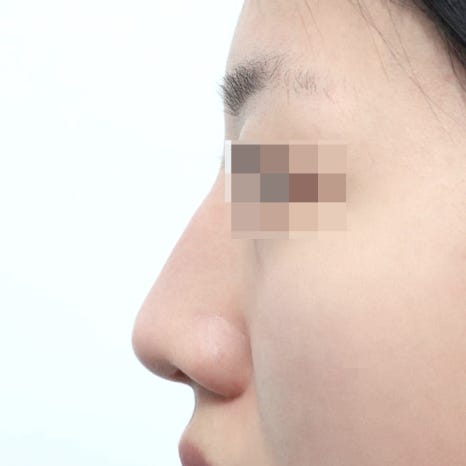 Nose Surgery Checklist: Be Sure to Check Before Your Consultation image 2