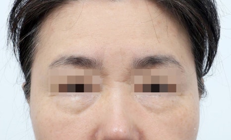 중년 눈밑주름없애는방법, 화장으로도 안 가려진다면 관련 이미지 4
