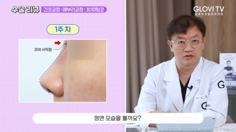매부리코 긴코 코성형 리뷰, 글로비 3D 피팅코수술 관련 이미지 7