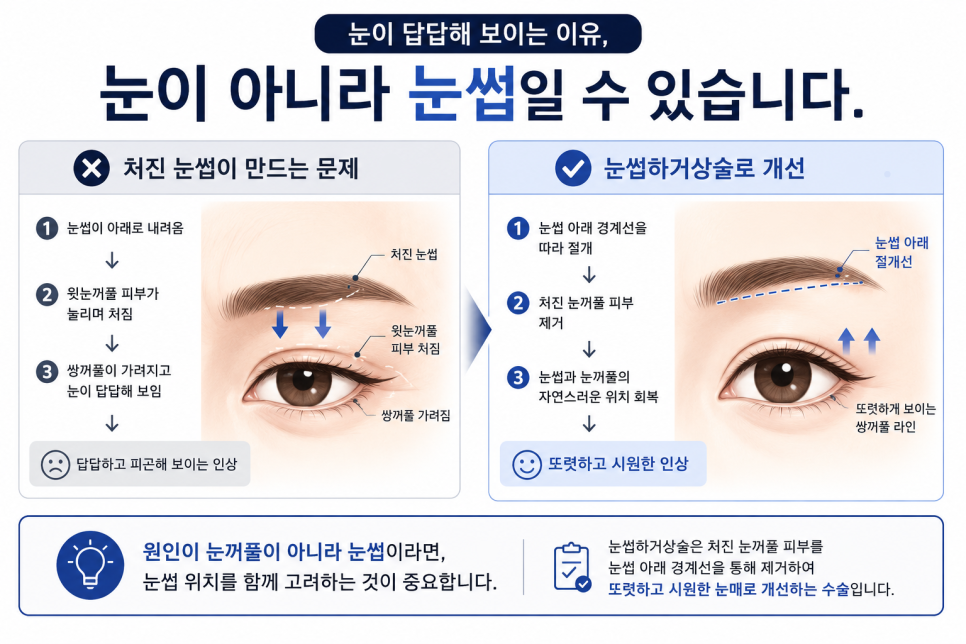 눈썹하거상술, 중년 눈매 교정 전 꼭 알아둘 사실 관련 이미지 2