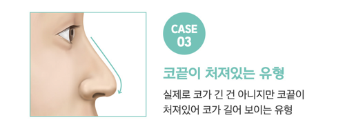 코성형 긴코, 어떻게 줄이고 자연스럽게 만들까? 관련 이미지 9