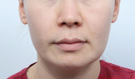 신사동 실리프팅 병원을 찾을 때 봐야 할 것은? 관련 이미지 6