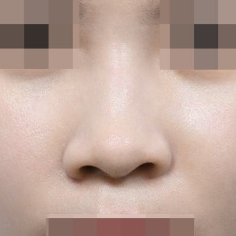 콧볼축소 부작용? 절개 위치부터 확인하세요 관련 이미지 8