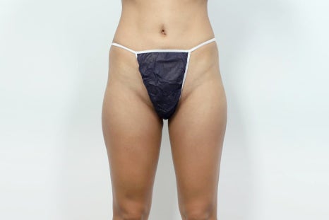 골반필러 가격, 이것 모르고 비교하면 손해입니다 관련 이미지 5