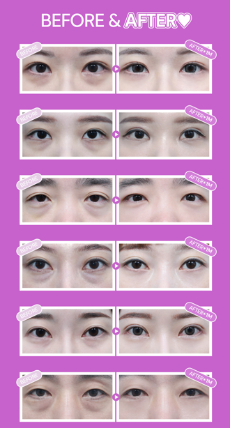 눈밑지방재배치수술 눈밑지란? 눈밑지 붓기 부작용은? 관련 이미지 6