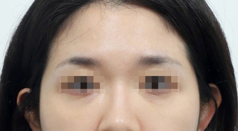 When Can You Return to Work, Exercise, and Wash Your Face After Lower-Eyelid Fat Repositioning? image 7