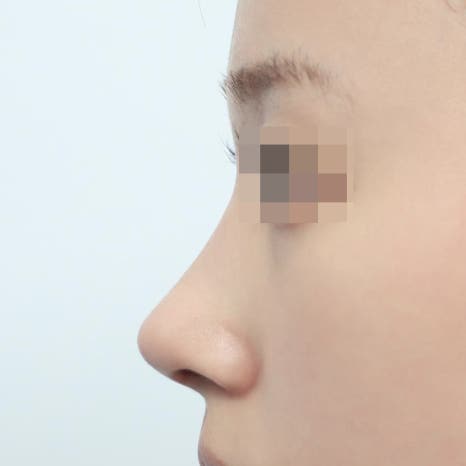 코재수술 시기 최소 6개월을 기다려야 하는 이유 관련 이미지 4