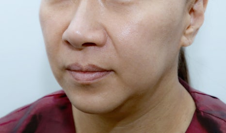 Why the Surgeon Matters More Than the Price When Choosing a Clinic Skilled in Thread Lifting image 4