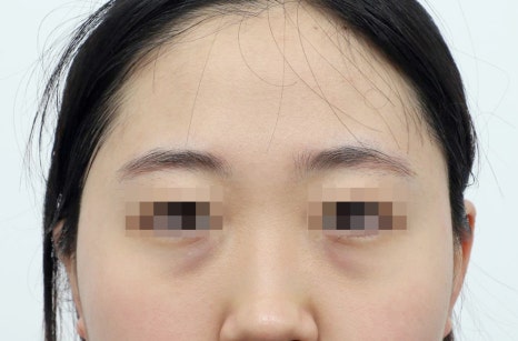 강남 눈밑지방재배치, 눈 밑 지방을 정리하는 방법 관련 이미지 5
