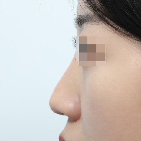 코재수술 시기 최소 6개월을 기다려야 하는 이유 관련 이미지 10