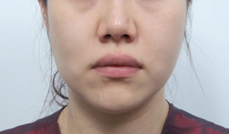 Why the Surgeon Matters More Than the Price When Choosing a Clinic Skilled in Thread Lifting image 8