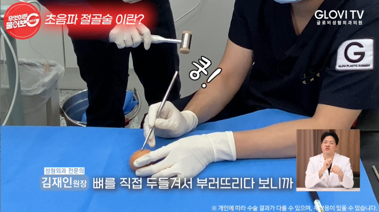 압구정역성형외과 코성형, 초음파절골술로 안전하게 관련 이미지 7