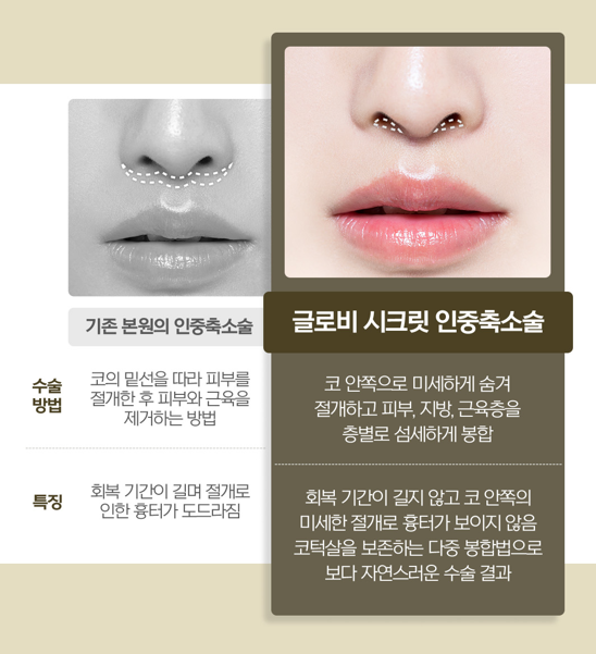 인중축소 잘하는곳, 입술이 어색해지는 부작용을 낮추는 수술법 관련 이미지 4