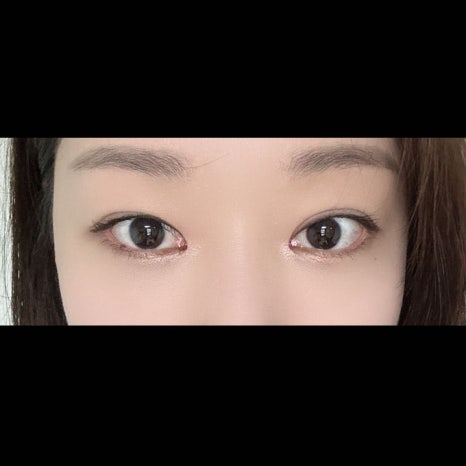 30대 눈밑지방재배치, 왜 지금 하는 게 맞는 걸까요? 관련 이미지 5