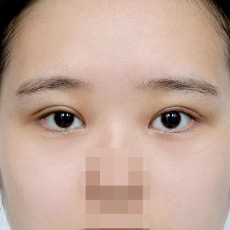 How to Choose a Clinic Specializing in Revision Eye Surgery image 5