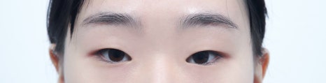 Worried About Re-adhesion After Lateral Canthoplasty? Those Concerns Disappear When the Surgical Technique Is Different image 2