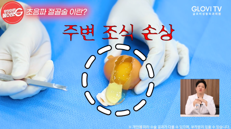 압구정역성형외과 코성형, 초음파절골술로 안전하게 관련 이미지 10