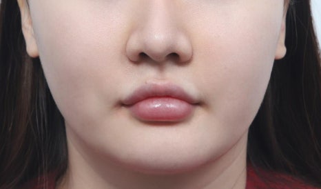 실리프팅 몇 줄이 적당한지 고민이라면 클릭 관련 이미지 3