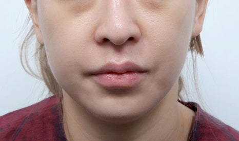 실리프팅 전후, 효과보다 먼저 알아야 할 것 관련 이미지 4