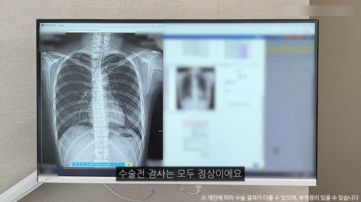 모티바가슴성형 리얼후기 1탄｜글로비성형외과의원 관련 이미지 9