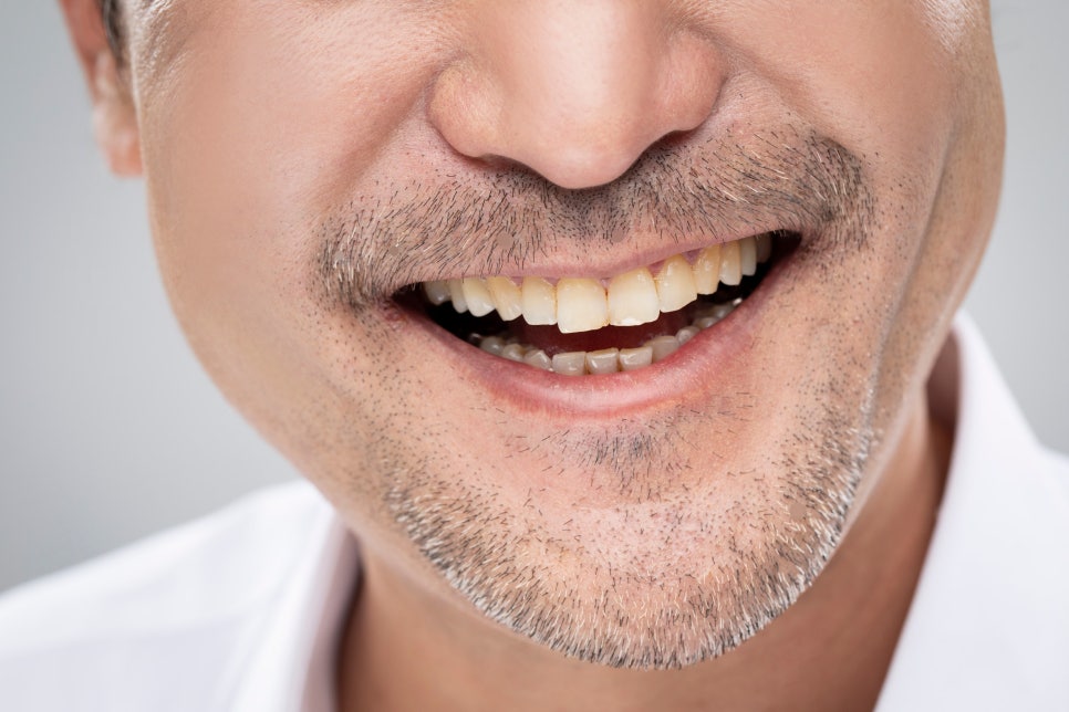 남자 인중축소, 받아도 되는 케이스인지부터 확인하세요 관련 이미지 3